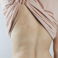 Bed bugs
