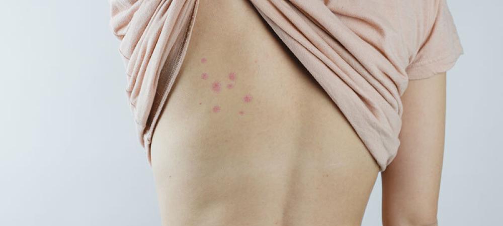 Bed bugs